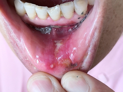 愛滋病感染性皮膚損害唇內側糜爛圖 愛滋病感染性皮膚損害唇內側糜爛圖