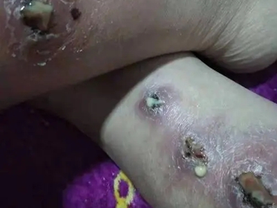 人工性脂膜炎小腿好幾處爛了流膿圖 人工性脂膜炎小腿好幾處爛了流膿圖