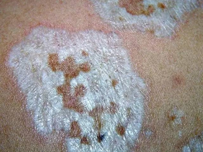 硬化萎縮性苔蘚後背長乳白色斑片圖 硬化萎縮性苔蘚後背長乳白色斑片圖
