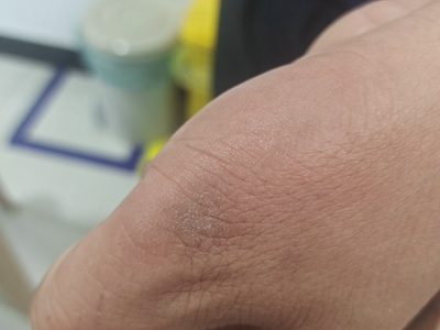 播散性神經性皮炎手部有褐色皮屑圖 播散性神經性皮炎手部有褐色皮屑圖