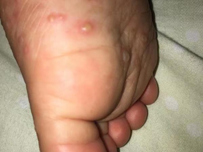 嬰兒肢端膿皰病腳底幾個水皰圖