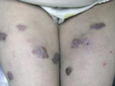 愛滋病皮膚腫瘤大腿部長黑色斑塊圖 愛滋病皮膚腫瘤大腿部長黑色斑塊圖