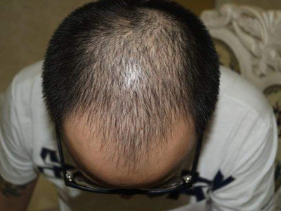 男性型脫髮頭上頭髮稀疏圖 男性型脫髮頭上頭髮稀疏圖