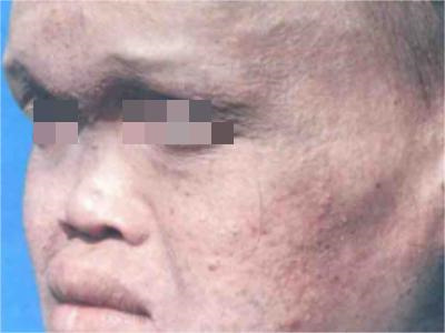 先天性外胚葉發育不良面部畸形圖 先天性外胚葉發育不良面部畸形圖
