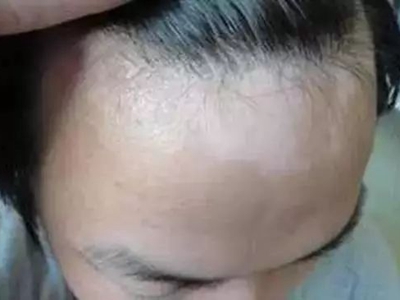 脫色素性痣前額上有白色斑塊圖 脫色素性痣前額上有白色斑塊圖