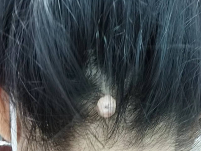 皮膚纖維瘤頭皮上一個圓形疙瘩圖 皮膚纖維瘤頭皮上一個圓形疙瘩圖