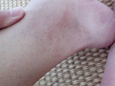 網狀肢端色素沉著腳踝有褐色小斑點圖 網狀肢端色素沉著腳踝有褐色小斑點圖