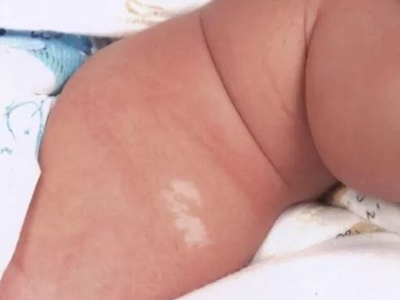 脫色素性痣大腿有塊白斑圖 脫色素性痣大腿有塊白斑圖