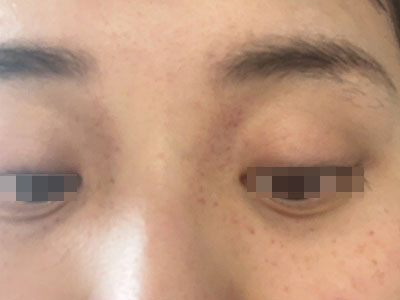 血管內壓力增多性紫癜眼周有紅點圖 血管內壓力增多性紫癜眼周有紅點圖