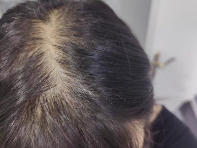 雄激素性脫髮頭頂發縫明顯圖