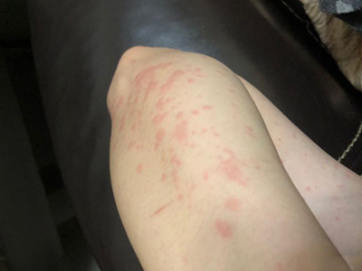 海鮮過敏胳膊上長了好多紅斑圖 海鮮過敏胳膊上長了好多紅斑圖