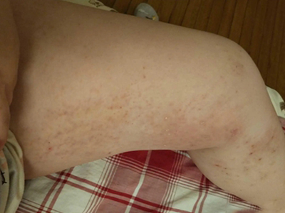 色素性痒疹大腿內側大片紅點有痂圖 色素性痒疹大腿內側大片紅點有痂圖