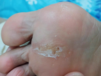 胼胝腳掌有個黃色硬塊上面有白皮圖