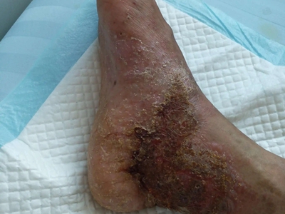 皰疹樣膿皰病腳踝皮膚破潰糜爛圖 皰疹樣膿皰病腳踝皮膚破潰糜爛圖