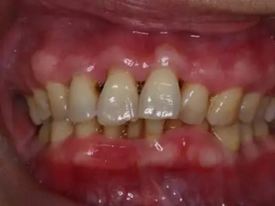 三期口腔梅毒牙齦上有白色腫塊圖