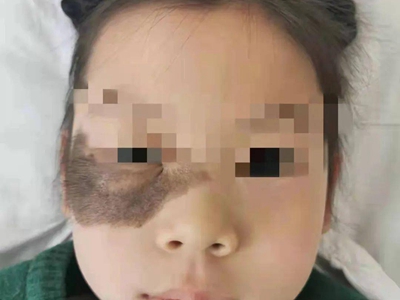 獸皮痣眼周有毛髮過長的黑褐色斑圖