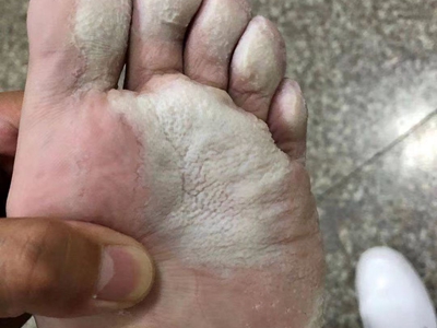 窩狀角質松解症腳底白色糜爛圖