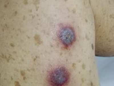 恙蟲病大腿上有兩塊焦痂和密集斑點圖 恙蟲病大腿上有兩塊焦痂和密集斑點圖