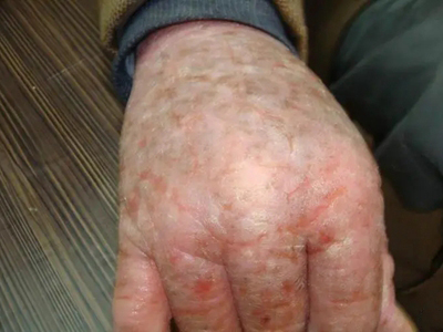 慢性光線性皮炎手背腫脹結痂糜爛圖 慢性光線性皮炎手背腫脹結痂糜爛圖