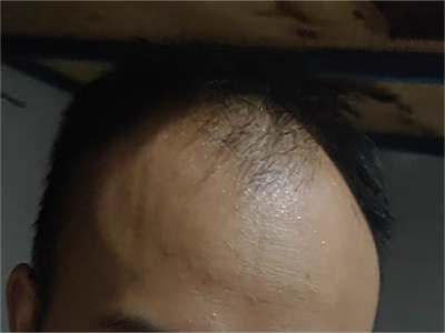 雄激素性脫髮前額的頭髮脫沒了圖 雄激素性脫髮前額的頭髮脫沒了圖