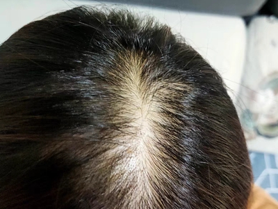 女性型脫髮頭頂禿了一塊露出頭皮圖
