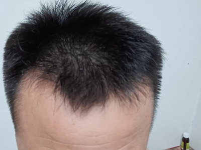 雄激素性脫髮頭頂和前額頭髮減少圖 雄激素性脫髮頭頂和前額頭髮減少圖