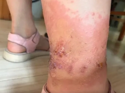 蠓蟲叮咬腳脖子破潰結痂發紅圖