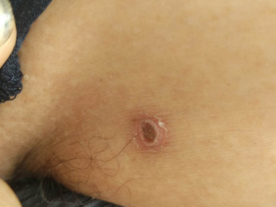 恙蟲病腋窩下圓形焦痂圖