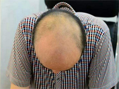 男性型脫髮頭上禿了一大片圖 男性型脫髮頭上禿了一大片圖