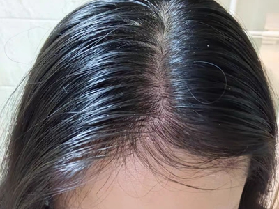 雄激素性脫髮頭髮油膩露頭皮圖 雄激素性脫髮頭髮油膩露頭皮圖