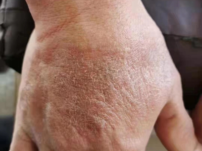 手部濕疹右手手背處皮膚粗糙圖