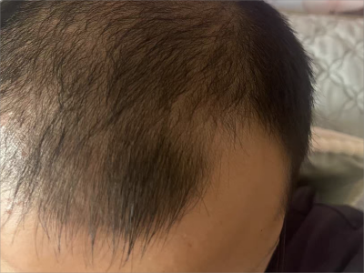 雄激素性脫髮左側額角大塊脫髮圖 雄激素性脫髮左側額角大塊脫髮圖