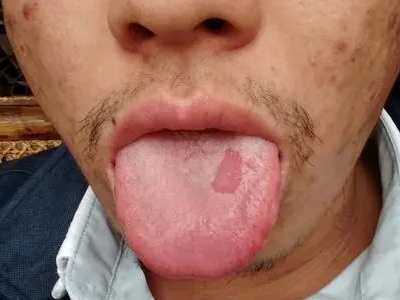二期口腔梅毒舌頭中間紅了一塊圖 二期口腔梅毒舌頭中間紅了一塊圖