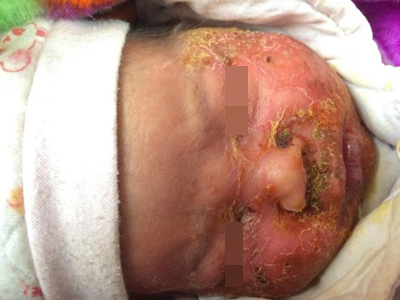 新生兒膿皰瘡面部大面積結痂圖 新生兒膿皰瘡面部大面積結痂圖