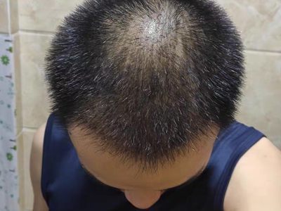 雄激素性脫髮頭頂毛髮十分稀疏圖 雄激素性脫髮頭頂毛髮十分稀疏圖