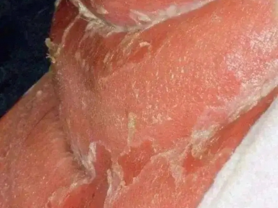 新生兒膿皰瘡大腿內側大面積脫皮圖