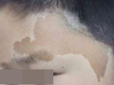 咖啡斑臉上有大塊不規則褐斑圖 咖啡斑臉上有大塊不規則褐斑圖