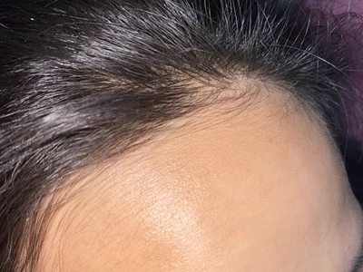 女性型脫髮前額髮際線處禿了一塊圖