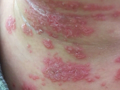 種痘樣水皰病脖子上一片紅斑水皰圖