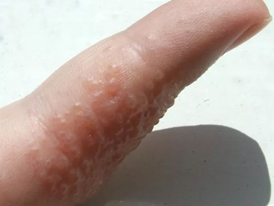 手部濕疹手指上有密密麻麻小水皰圖