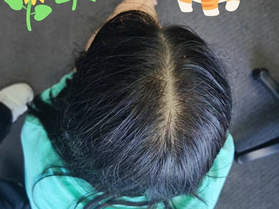 女性型脫髮頭頂發縫很寬圖