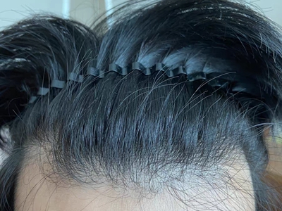 雄激素性脫髮前額髮際線升高圖 雄激素性脫髮前額髮際線升高圖