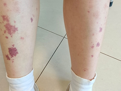 小兒過敏性紫癜小腿上長紫紅色斑圖