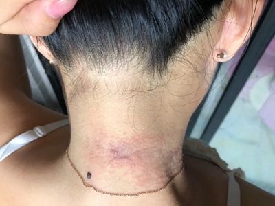 色素性痒疹脖子紅棕色斑皮膚粗糙圖 色素性痒疹脖子紅棕色斑皮膚粗糙圖