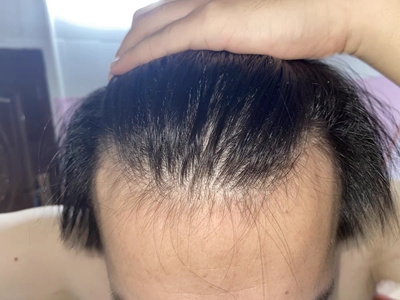 雄激素性脫髮頭髮脫落導致額頭變高圖