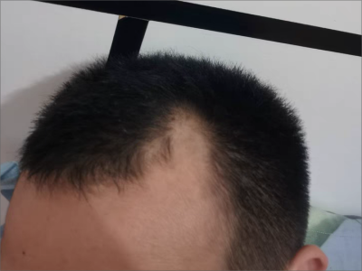 雄激素性脫髮前額角頭髮缺失圖
