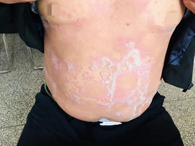尋常型銀屑病腹部有白斑圖 尋常型銀屑病腹部有白斑圖