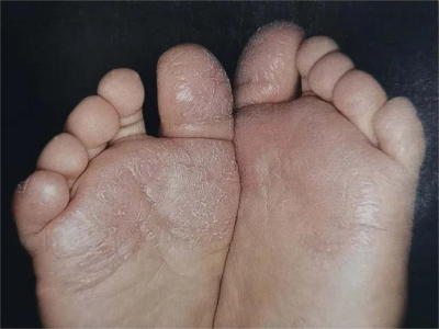 幼年跖部皮病腳底乾燥有很多裂紋圖