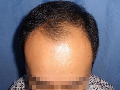 男性型脫髮前額髮際線大片後移圖