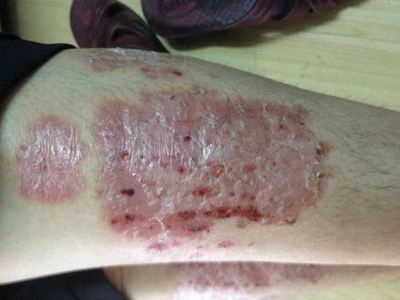 尋常型銀屑病小腿大片紅斑和血痂圖 尋常型銀屑病小腿大片紅斑和血痂圖